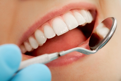 Composite Fillings